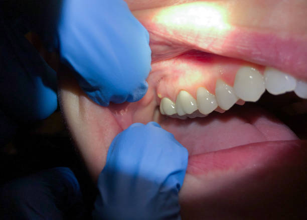 Best Knocked-Out Tooth Emergency  in Saginaw, TX